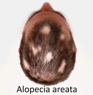 Bee Venom Alopecia Areata