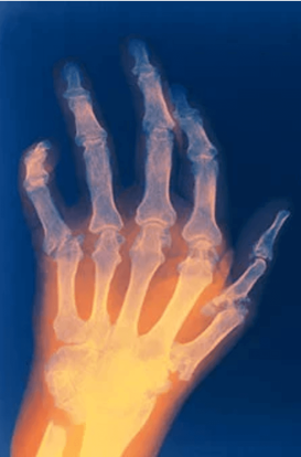 What Is Rheumatoid Arthritis