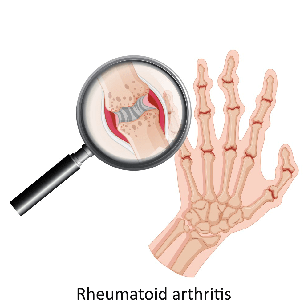 ​Rheumatoid arthritis bee venom treatmenticture